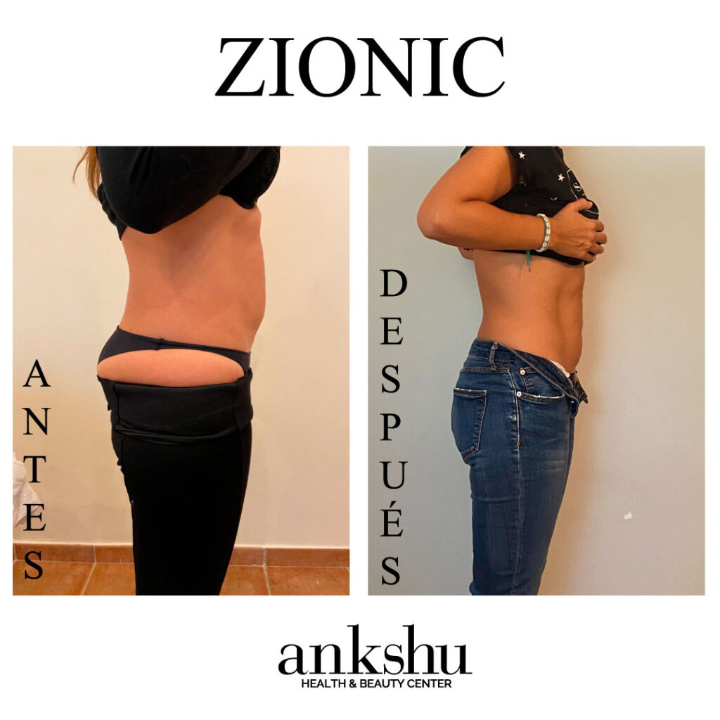 antes-y-despues_barriga_lateral_zionic