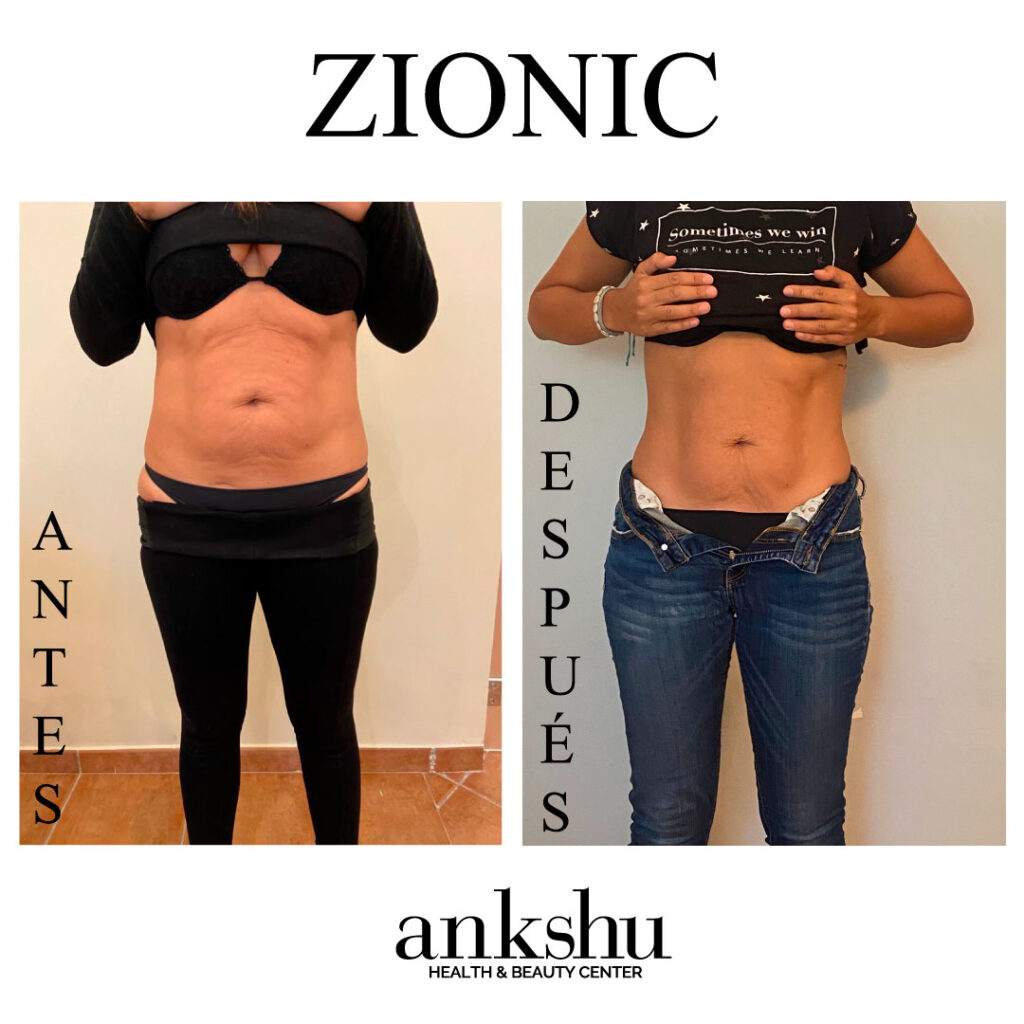 antes-y-despues_barriga_zionic